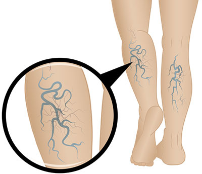 stadiul de dezvoltare a piciorului varicose
