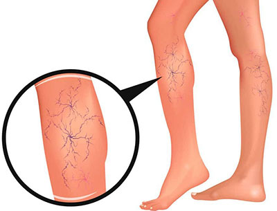 tratamentul venelor varicoase pentru vârstnici gel de picior varicos